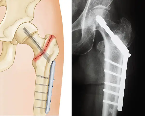 Orthopedic Doctor in Kaushambi
