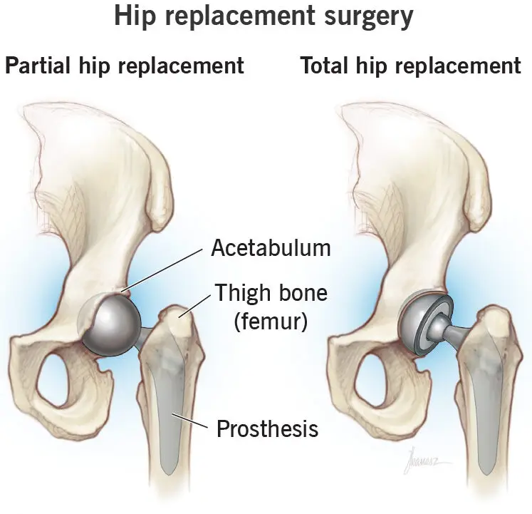Hip Replacement Surgery