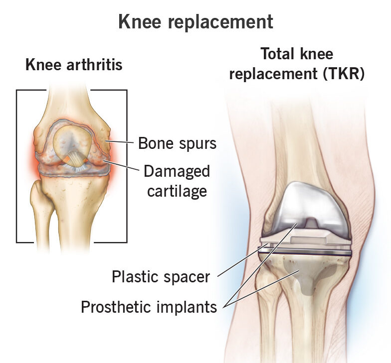 knee Replacement