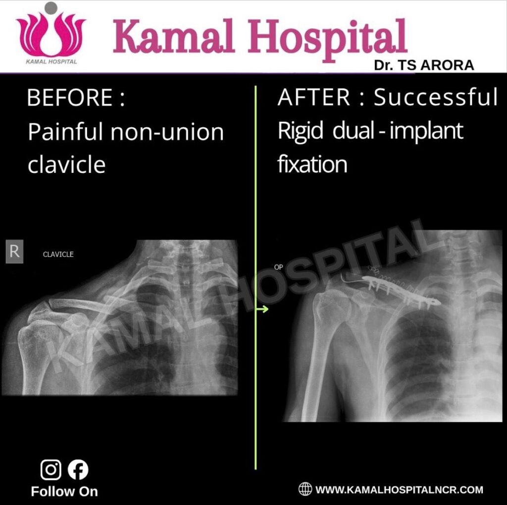Painful Non-union clavicle