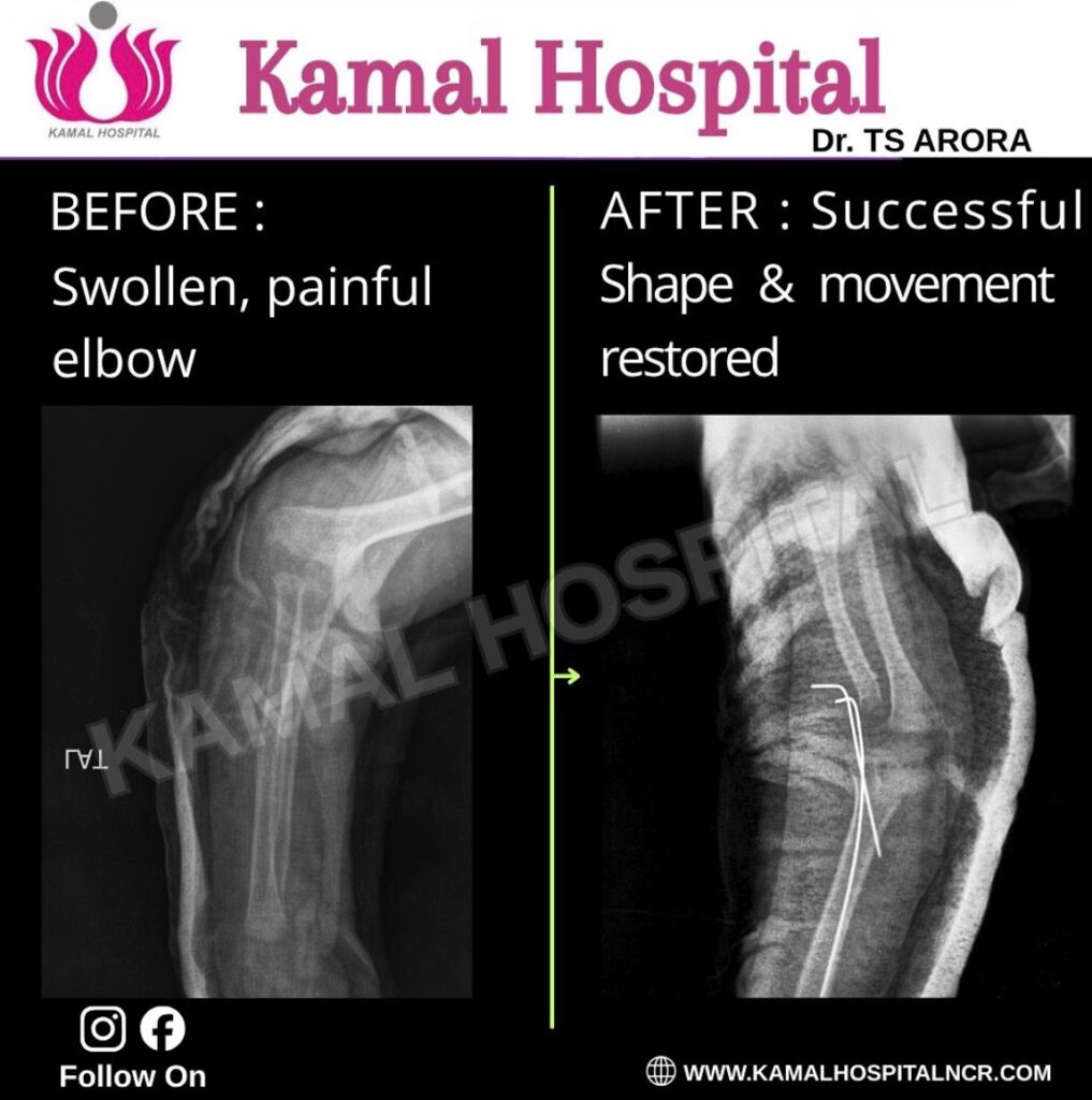Orthopedic Hospital in Ghaziabad